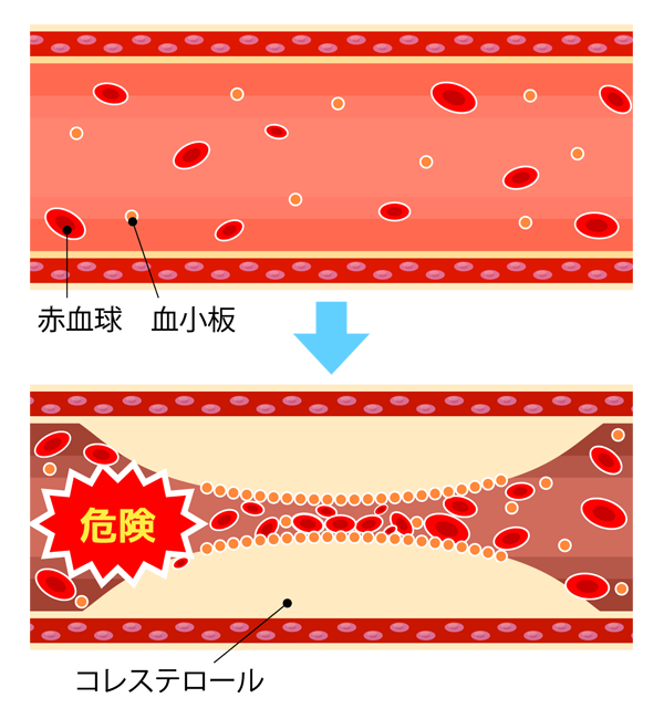 動脈硬化